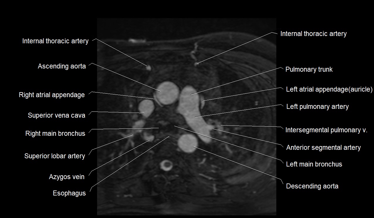 MRI heart coronary arteries and coronary veins anatomy axial image 1.jpg